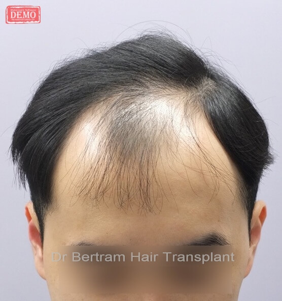 Before and After Hair Transplant Dr Bertram Hair Transplant